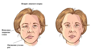 igloterapia_zhezkazgan - ☯️Иглоукалывание при неврите лицевого нерва ❇️ЛИЦЕВОЙ  НЕРВ Это двигательный нерв, иннервирующий мимические мышцы лица. Но  некоторые его ответвления имеют и чувствительные волокна. Каналы, по  которым проходит нерв, очень ...