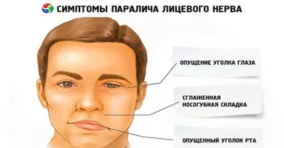 Иглоукалывание при лечении лицевого и тройничного нерва - Общая медицина