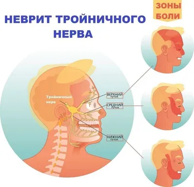 Неврит лицевого нерва. Лечение и симптомы воспаленного лицевого нерва.