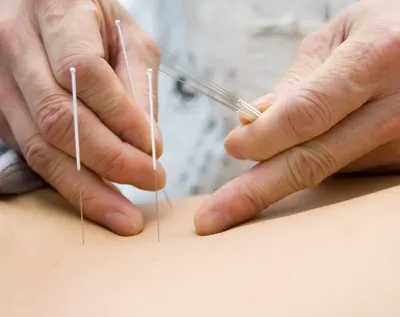 Лечение... - Acupunctura.Иглоукалывание.Рефлексотерапия Одесса | Facebook