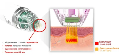 Микроигольчатый RF лифтинг - Lazerjazz.ru