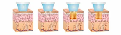 Микроигольчатый RF лифтинг