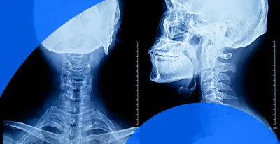 How are X-rays Produced? - Health Images