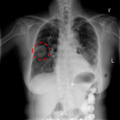 Four day old baby, X-ray - Stock Image - F035/6520 - Science Photo Library