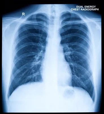 https://my.clevelandclinic.org/health/diagnostics/10228-chest-x-ray