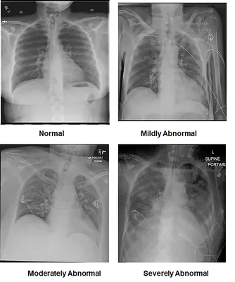 Heart failure: How does it appear on a chest X-ray?