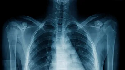 Abnormal chest x-ray: what does it mean? | Top Doctors