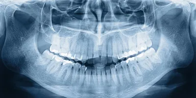 Cureus | COVID-19 vs. Influenza: A Chest X-ray Comparison | Article