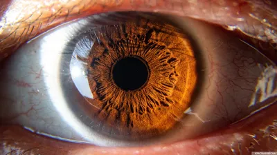 Симптомы глаукомы, причины и лечение