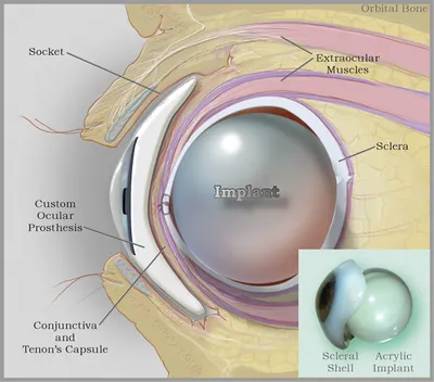 Имплант глаза показал хорошие результаты против макулодистрофии - Собеседник