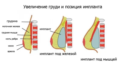 Увеличение молочных желез под мышцу - Вирабян Л. В.