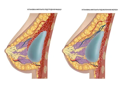 Импланты грудные: что это, виды, формы, размеры, объемы, как выглядят, как  выбрать, способы установки, нужно ли менять