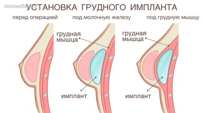 Грудные импланты и BIA-ALCL: риски, симптомы, лечение