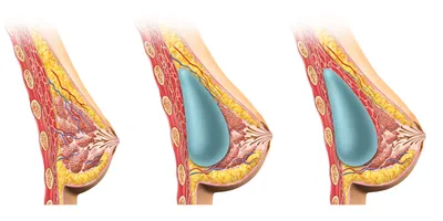 Пластика груди - делать или не делать? Все \"за\" и \"против\" о процедуре ➡  Медицинский центр Молекула | Молекула