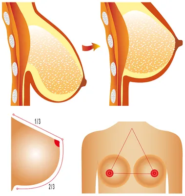 Увеличение груди