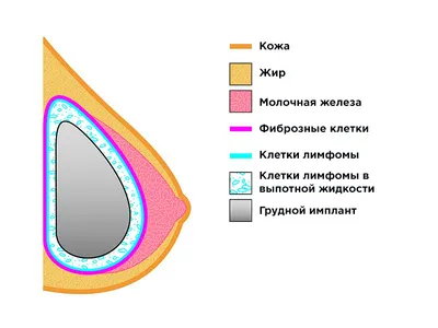 Грудные импланты - Сколько стоит сделать лучшую силиконовую грудь - MedTour