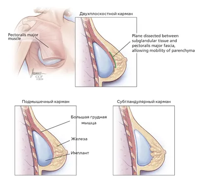 Реэндопротезирование груди. Повторная пластика груди и замена импланта:  когда и кому нужна?