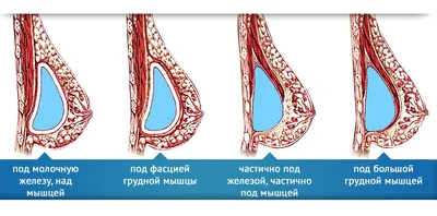 Ю.С.Васильев - Под мышцу или под железу?