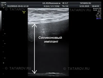 Асимметрия после маммопластики: почему возникает и как избежать деформации  после пластики груди