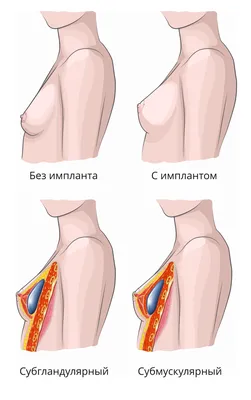 Ю.С.Васильев - Под мышцу или под железу?