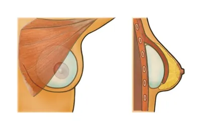 Идеальная грудь без имплантов