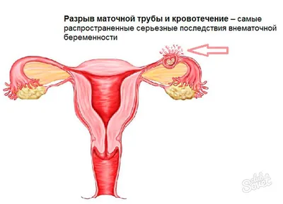 Имплантационное кровотечение на 14 день. Как отличить имплантационное  кровотечение от месячных. Имплантационное кровотечение и тесты | На ксида ру