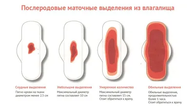 Можно ли отличить обильные месячные от кровотечения