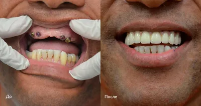 Имплантация Dentium в Москве: цены, фото до и после, отзывы | Стоимость  имплантации Dentium в клинике Seline