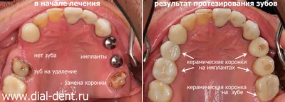 Установка зубных имплантов в Минске, установка импланта зуба цена под ключ