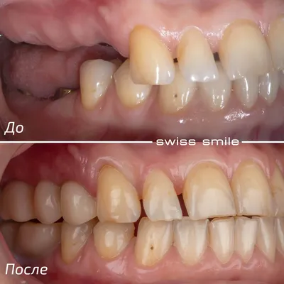 Имплантация зубов под ключ в клинике Swiss-smile Москва