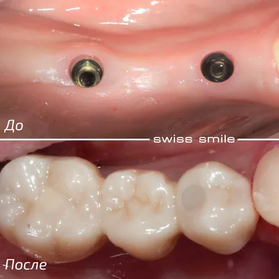 Имплантация переднего зуба — D.Ante