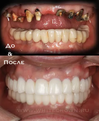 Имплантация зубов под ключ в клинике Swiss-smile Москва