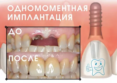 Одномоментная имплантация - пример с фото. Как это делают?