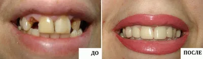 Имплантация двух зубов в Москве - цена под ключ в стоматологии Elite Denta