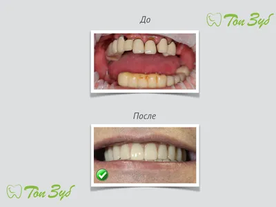 Недорогая имплантация зубов в г. Саратов с максимальной гарантией