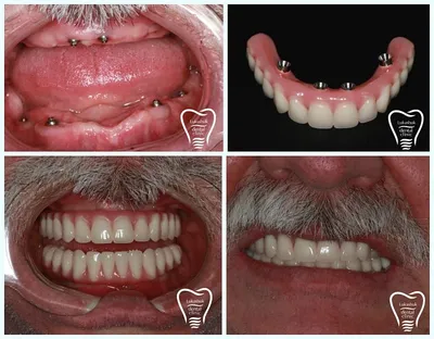 Одномоментная имплантация зубов что это такое, плюсы и минусы, цены  доступные в клинике Мона Лиза