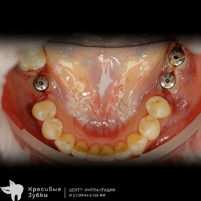 Полная имплантация всех зубов в Москве под ключ, цены от Дантистофф