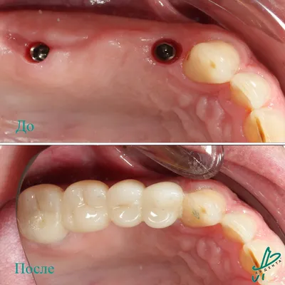 Импланты Зубов Какие Выбрать Чем Различаются Люмидент