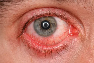 Красные глаза: причины, лечение, болезни. Что делать, если лопнул сосуд?