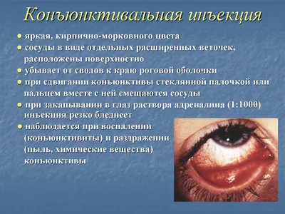 Осложнения после уколов в стекловидное тело глаза (интравитреальные инъекции )