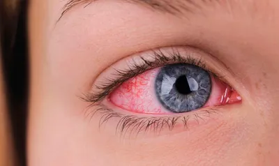 Красные сосуды в глазах: причины, лечение, профилактика «Ochkov.net»