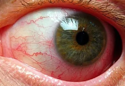 Атеросклероз сетчатки глаза | Клиника доктора Шишонина