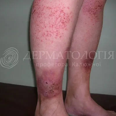 Инфекция кожи стоковое изображение. изображение насчитывающей медицинско -  29559477