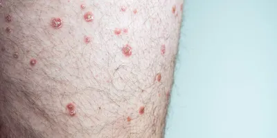Заболевание кожи Vitiligo стоковое изображение. изображение насчитывающей  пятно - 29466987