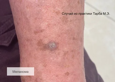 Лечение вирусных инфекций кожи в Киеве | Brenner Clinic