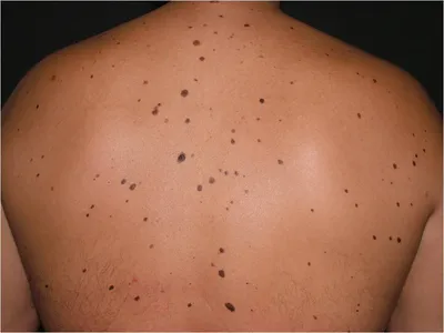 Презентация заболевания кожи | PDF