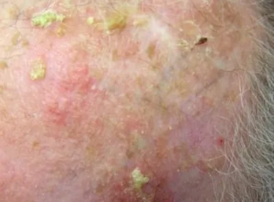Бактериальные инфекции кожи: какие бывают, как лечить. Правила профилактики
