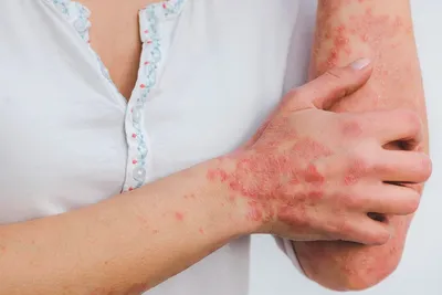 Инфекции кожи и мягких тканей - YouTube