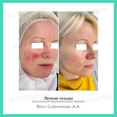 Доброкачественные новообразования кожи: виды, лечение | Удаление  доброкачественных новообразований в Москве в Клинике подологии Полёт