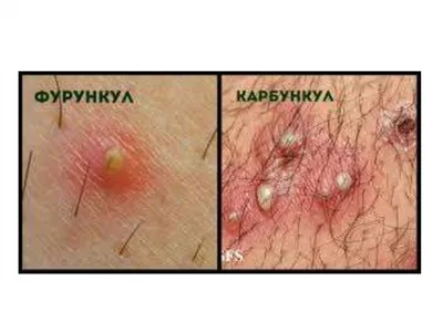 Хирургические инфекции кожи и мягких тканей - online presentation